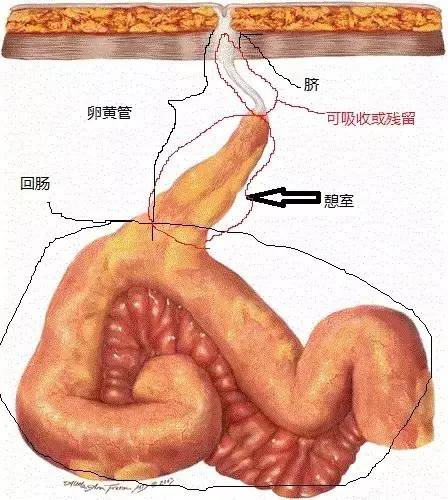 【病例】Meckel憩室炎1例 【病例】Meckel憩室炎1例