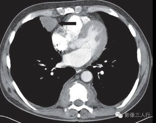 髓外造血（extramedullary hematopoiesis, EMH）