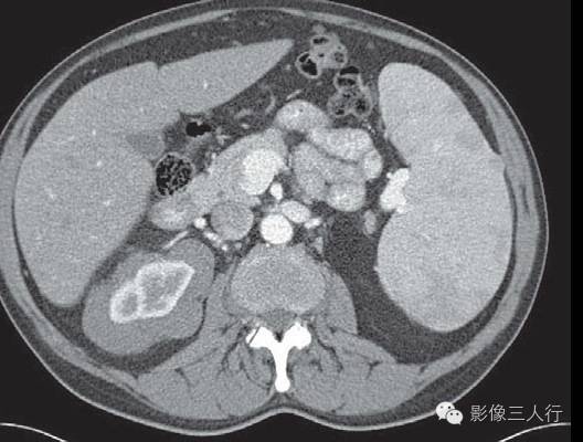 髓外造血（extramedullary hematopoiesis, EMH）
