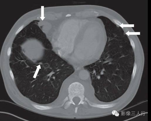 髓外造血（extramedullary hematopoiesis, EMH）