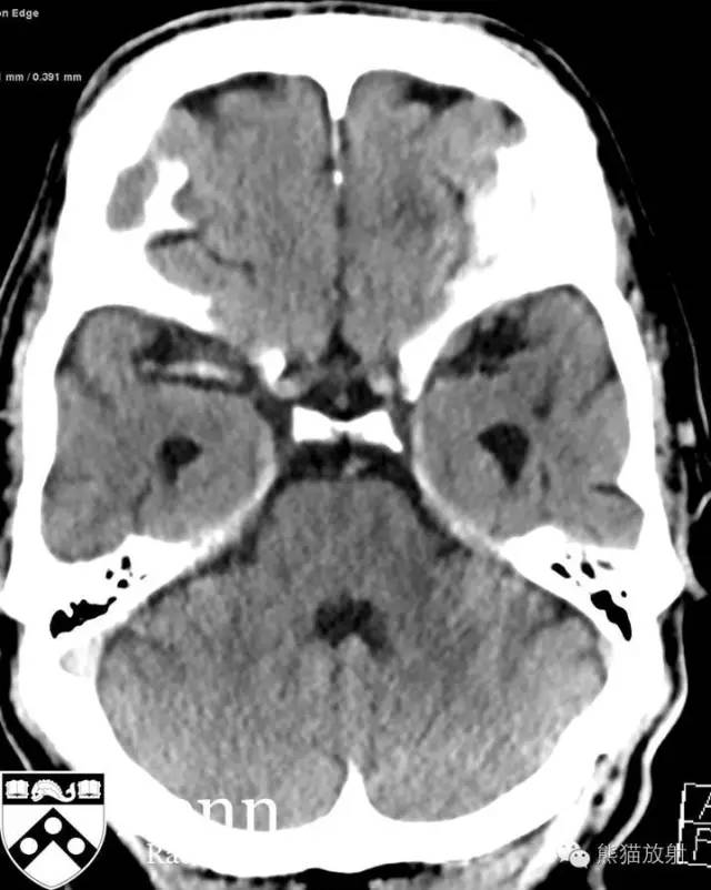 【双语病例】右侧大脑中动脉急性栓塞性梗死1例 【双语病例】右侧大脑中动脉急性栓塞性梗死1例