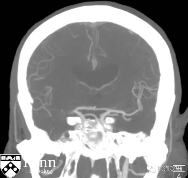 【双语病例】右侧大脑中动脉急性栓塞性梗死1例 【双语病例】右侧大脑中动脉急性栓塞性梗死1例