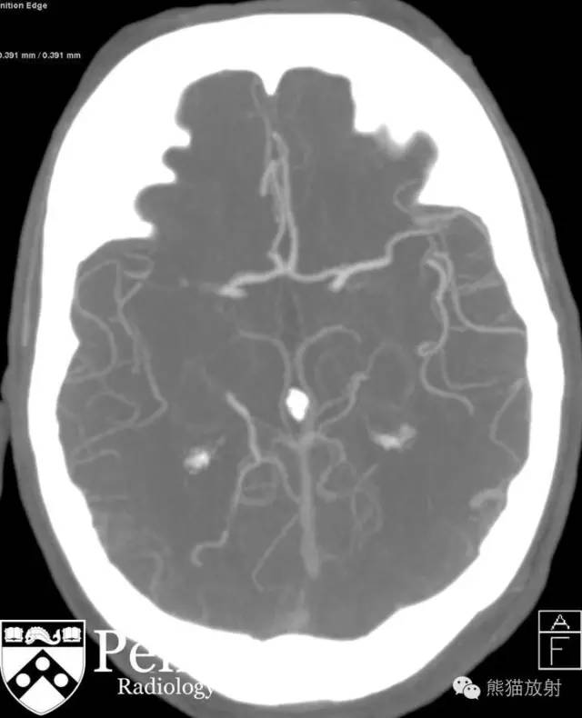 【双语病例】右侧大脑中动脉急性栓塞性梗死1例 【双语病例】右侧大脑中动脉急性栓塞性梗死1例