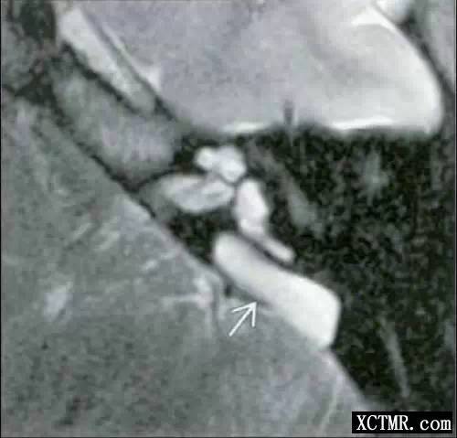 桥小脑角区囊性病变影像病例总结 桥小脑角区囊性病变影像病例总结
