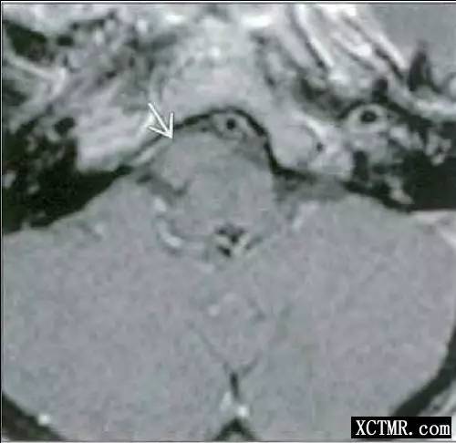 桥小脑角区囊性病变影像病例总结 桥小脑角区囊性病变影像病例总结