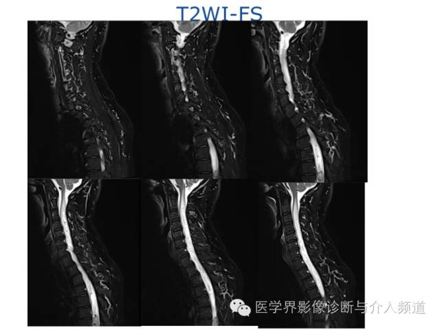 【病例】血管母细胞瘤1例MR影像表现
