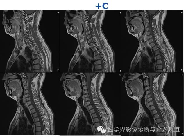 【病例】血管母细胞瘤1例MR影像表现 【病例】血管母细胞瘤1例MR影像表现