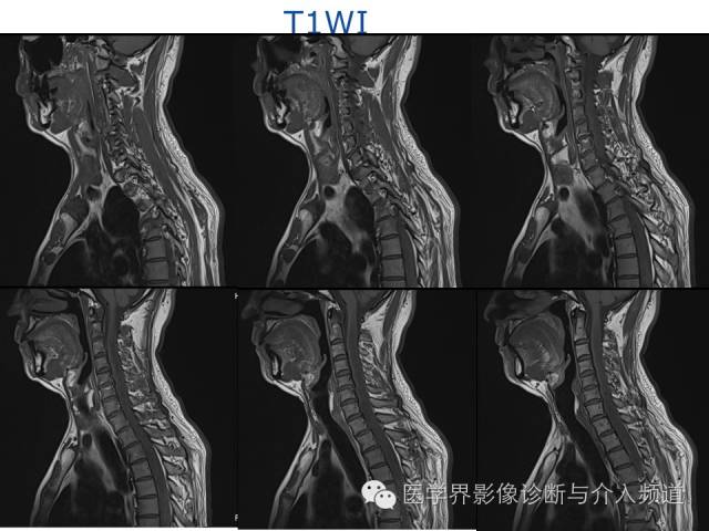 【病例】血管母细胞瘤1例MR影像表现 【病例】血管母细胞瘤1例MR影像表现
