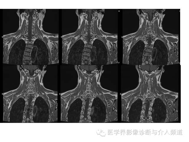 【病例】血管母细胞瘤1例MR影像表现 【病例】血管母细胞瘤1例MR影像表现