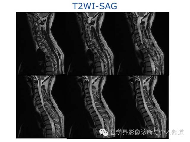 【病例】血管母细胞瘤1例MR影像表现 【病例】血管母细胞瘤1例MR影像表现
