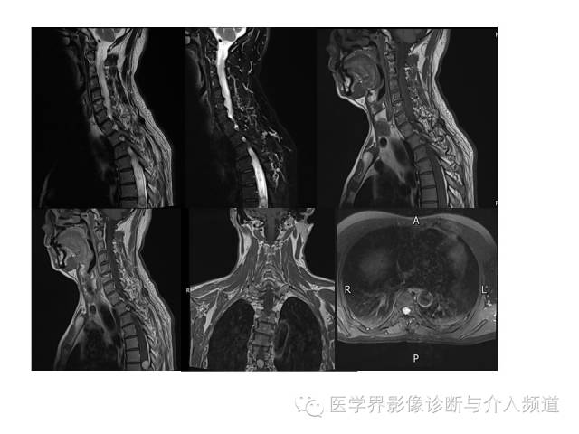【病例】血管母细胞瘤1例MR影像表现 【病例】血管母细胞瘤1例MR影像表现