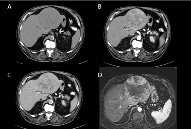 【影像与病理对照】七种常见肝脏肿瘤