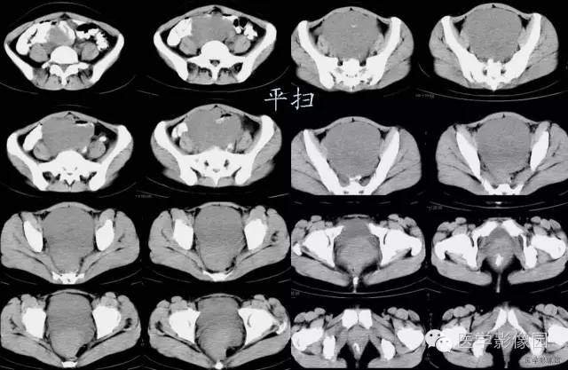 【病例】巨大无坏死的肠道间质瘤1例CT