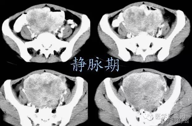 【病例】巨大无坏死的肠道间质瘤1例CT