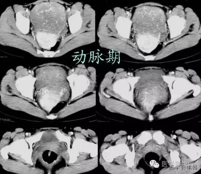 【病例】巨大无坏死的肠道间质瘤1例CT