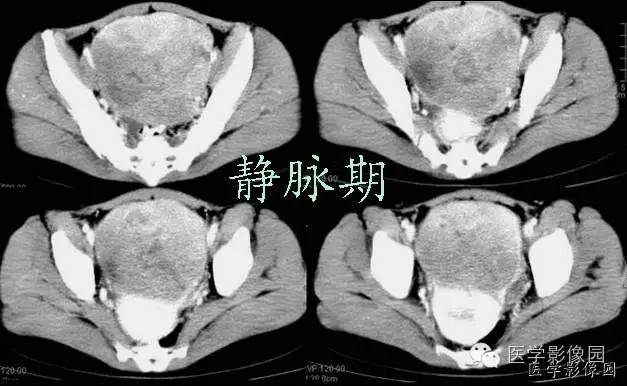 【病例】巨大无坏死的肠道间质瘤1例CT