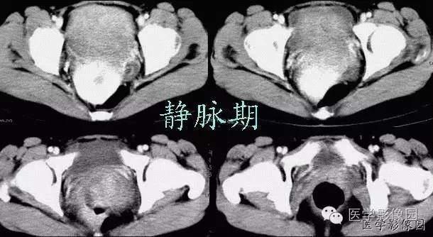 【病例】巨大无坏死的肠道间质瘤1例CT