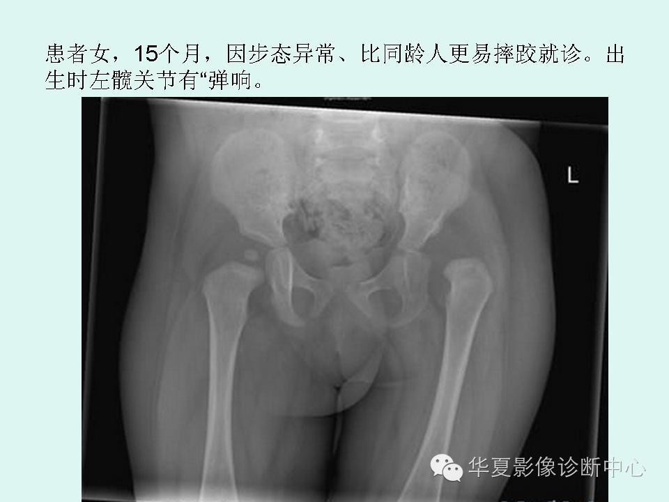【病例】左髋关节发育不良1例X线影像表现