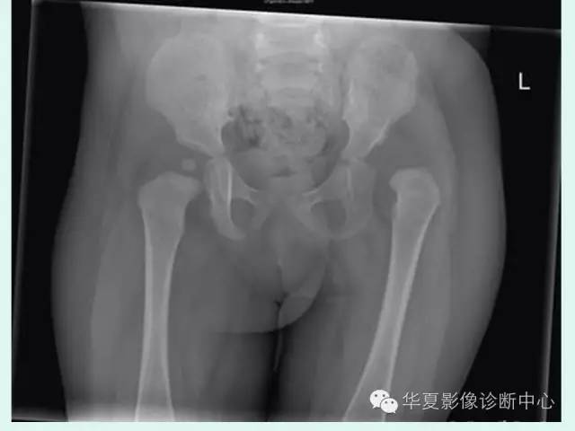 【病例】左髋关节发育不良1例X线影像表现