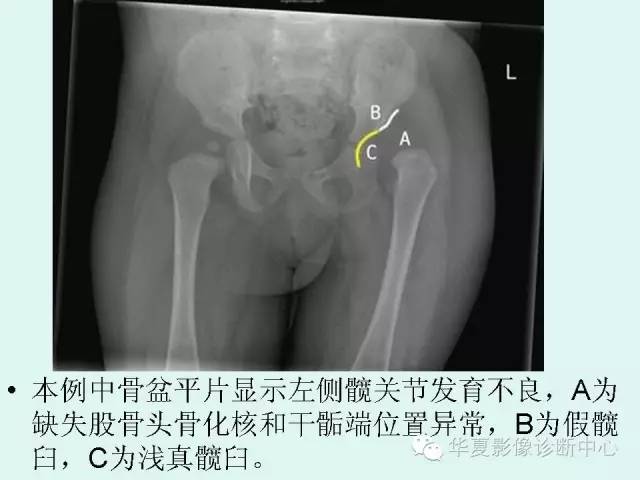 【病例】左髋关节发育不良1例X线影像表现