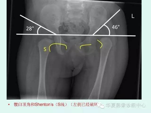 【病例】左髋关节发育不良1例X线影像表现