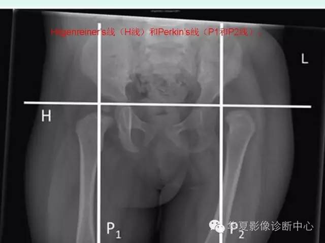 【病例】左髋关节发育不良1例X线影像表现