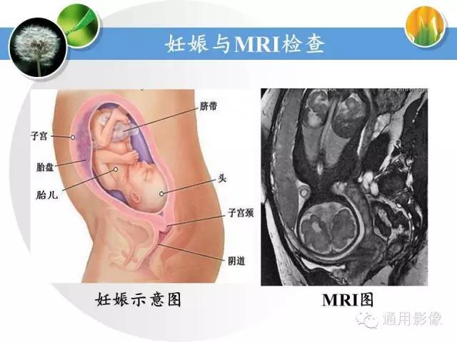 【PPT】异常妊娠的MRI表现