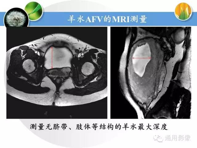 【PPT】异常妊娠的MRI表现
