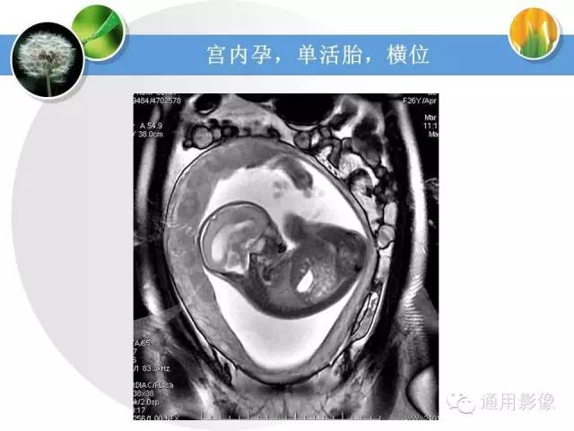 【PPT】异常妊娠的MRI表现