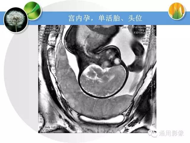 【PPT】异常妊娠的MRI表现