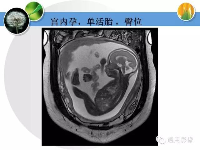 【PPT】异常妊娠的MRI表现