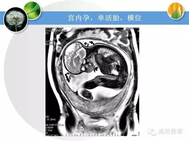 【PPT】异常妊娠的MRI表现