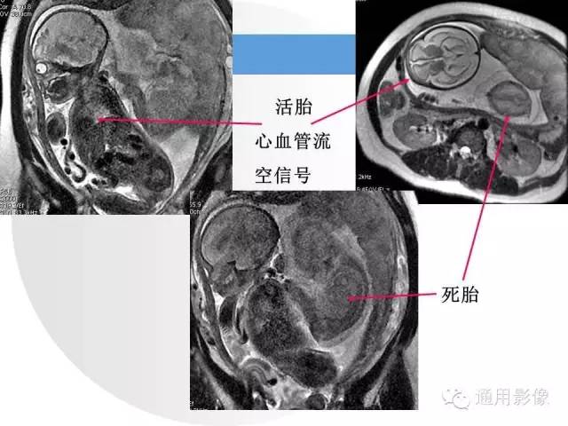 【PPT】异常妊娠的MRI表现