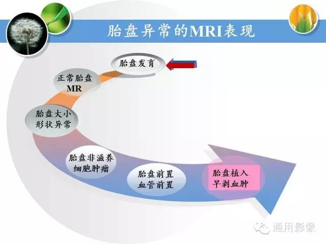 【PPT】异常妊娠的MRI表现