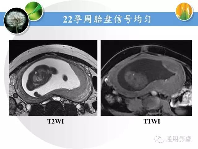 【PPT】异常妊娠的MRI表现