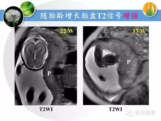 【PPT】异常妊娠的MRI表现