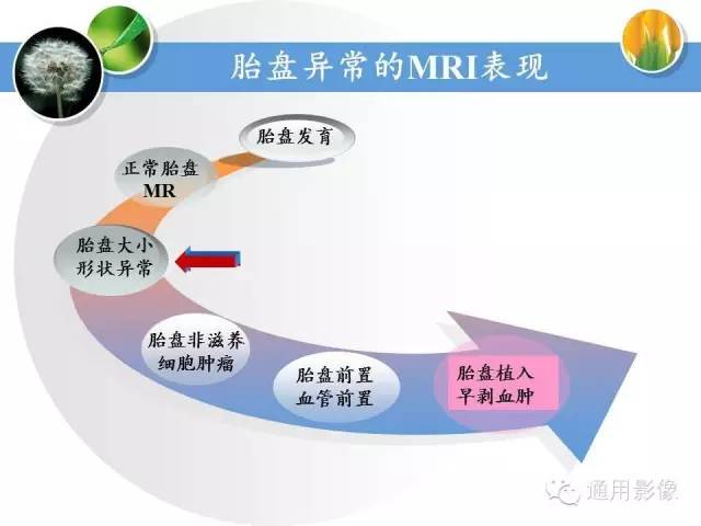 【PPT】异常妊娠的MRI表现