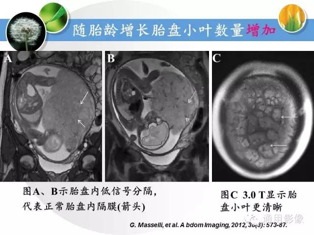 【PPT】异常妊娠的MRI表现