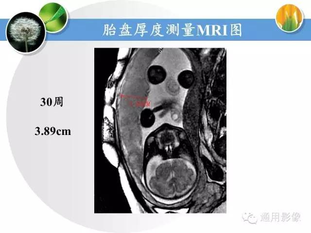 【PPT】异常妊娠的MRI表现