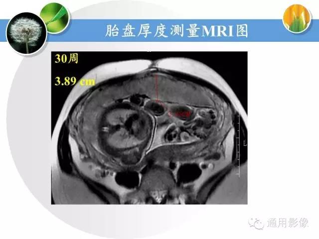 【PPT】异常妊娠的MRI表现