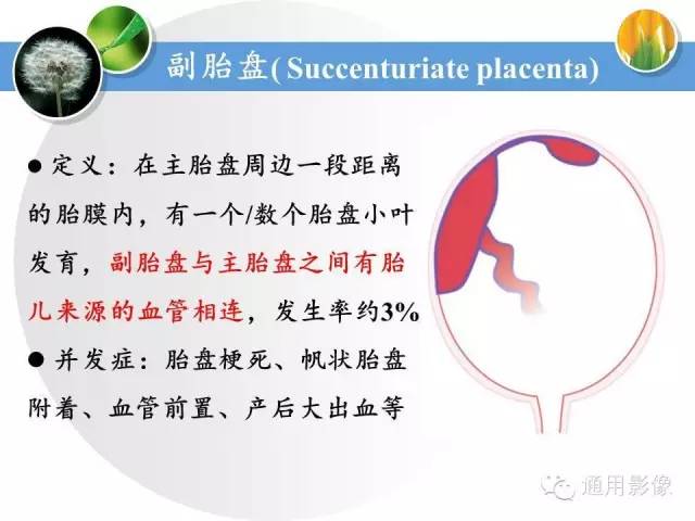【PPT】异常妊娠的MRI表现