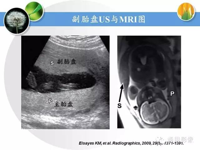 【PPT】异常妊娠的MRI表现