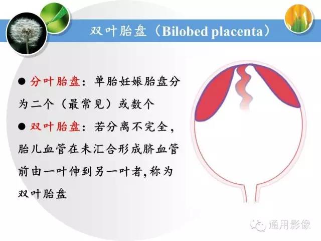 【PPT】异常妊娠的MRI表现