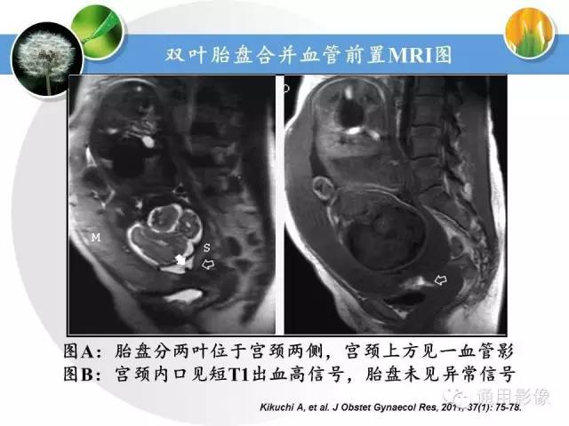【PPT】异常妊娠的MRI表现