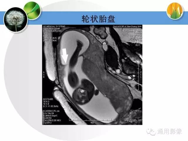 【PPT】异常妊娠的MRI表现
