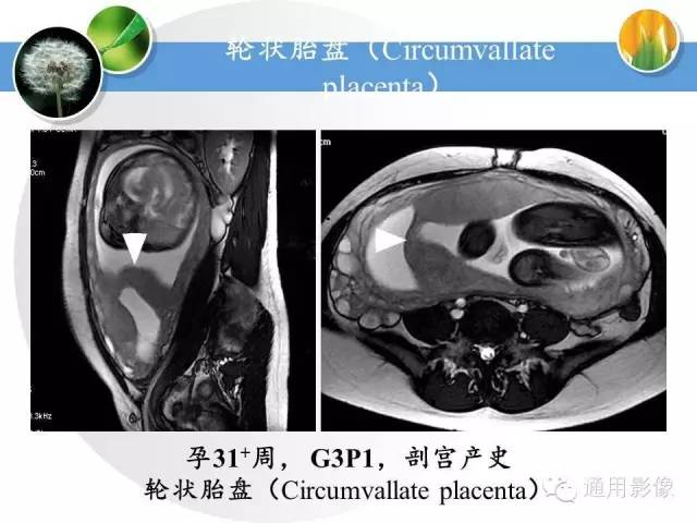 【PPT】异常妊娠的MRI表现