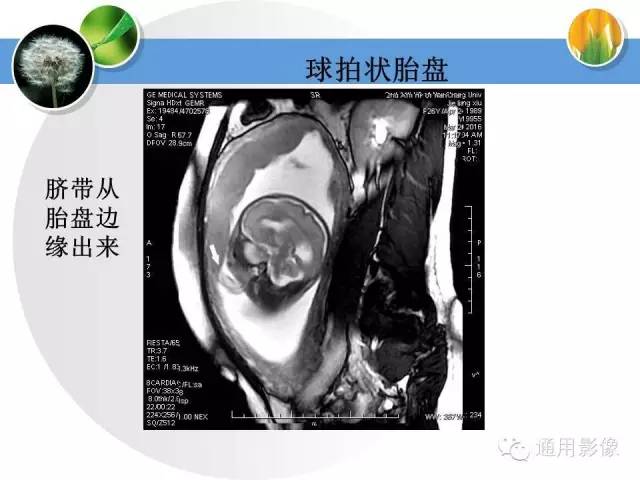 【PPT】异常妊娠的MRI表现