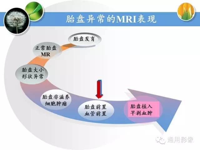 【PPT】异常妊娠的MRI表现