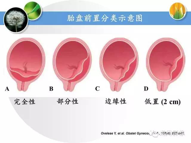 【PPT】异常妊娠的MRI表现