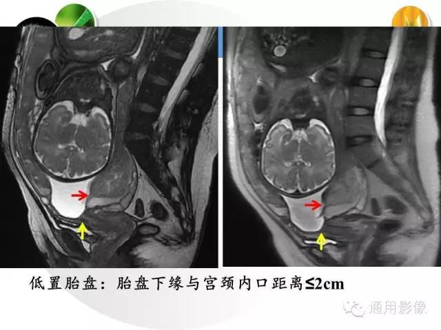 【PPT】异常妊娠的MRI表现